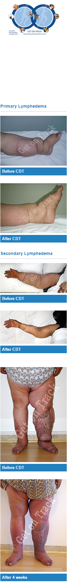 Complete Decongestive Therapy (CDT)