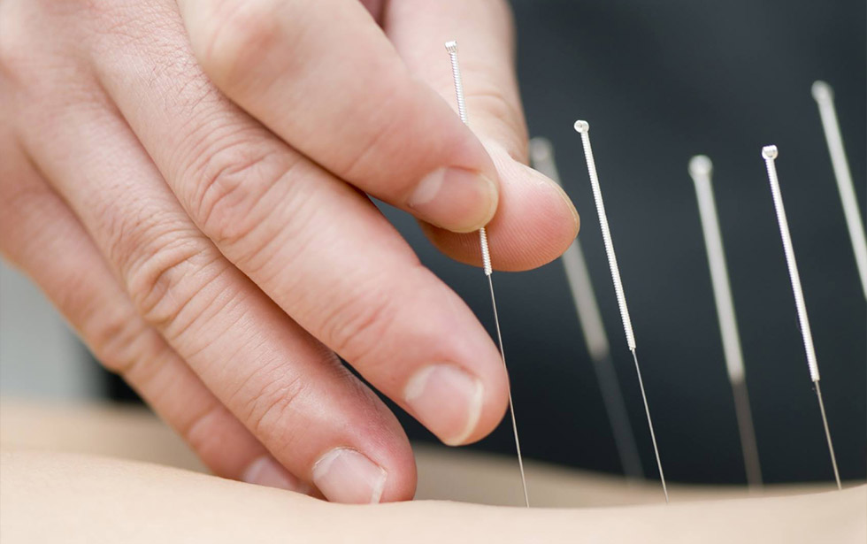 Benefits of Dry needling