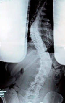 Diagnose Of Scoliosis